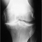 arthritis+knee